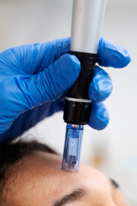 microagulhamento clinica lais loraine tratamento estetico facial balneario camboriu